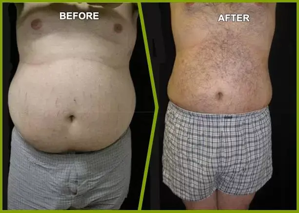 Before and after - Fat transfer