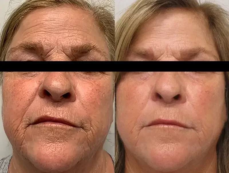 Candidate for Morpheus8 Treatment