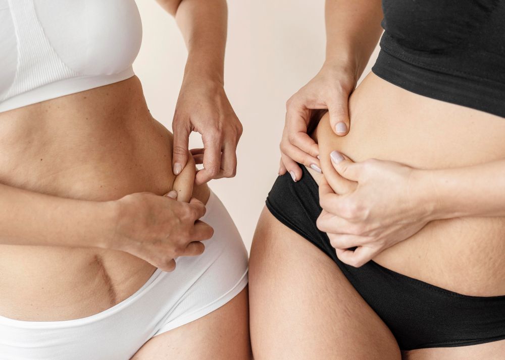 Liposuction vs Tummy Tuck