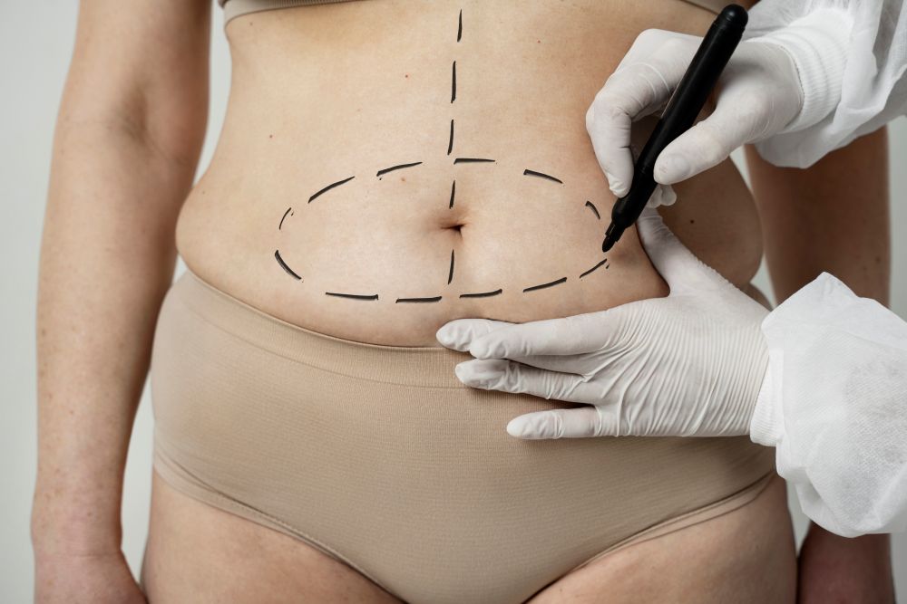 Liposuction vs tummy tuck results