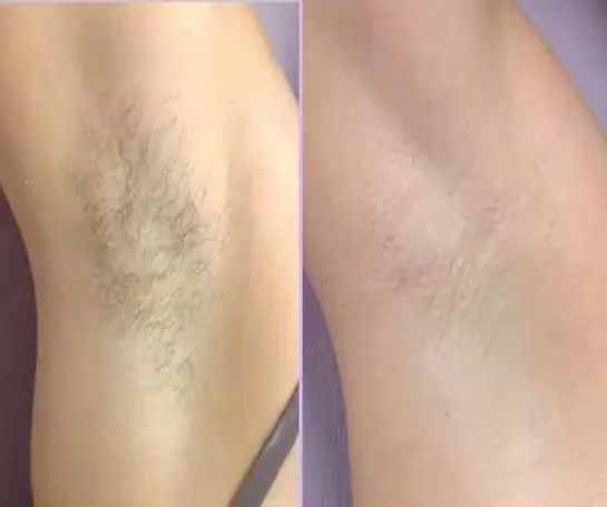 Hair removal before after image