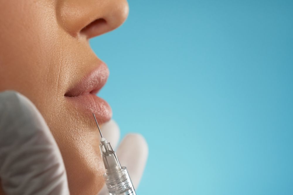 Lip filler